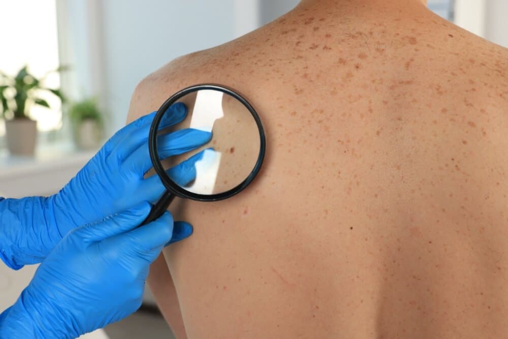 Dermatologist in Bensalem performing a skin cancer screening on a patient's back