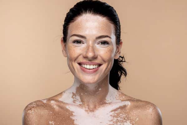 Vitiligo Treatment Options