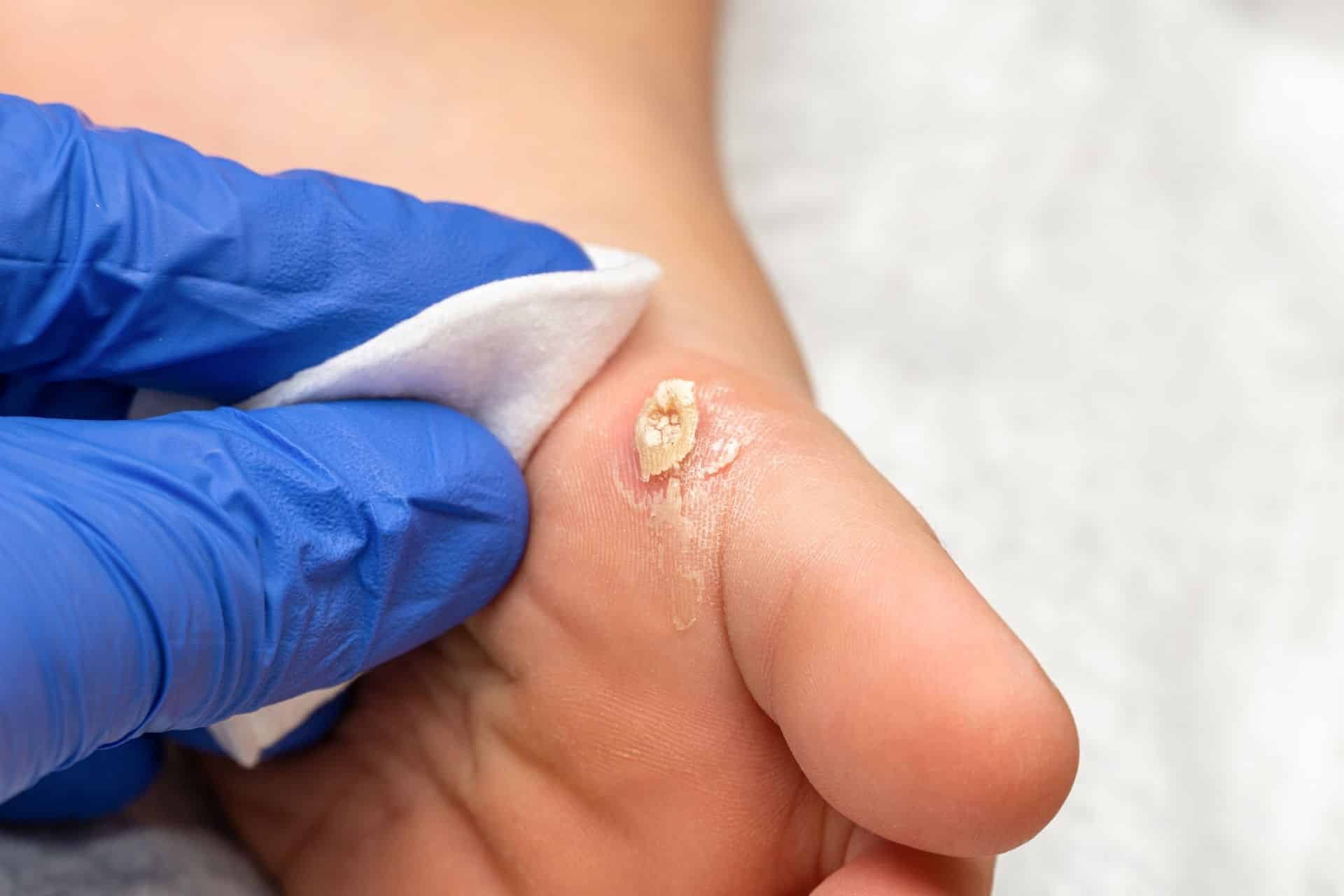 Wart & Molluscum Treatment